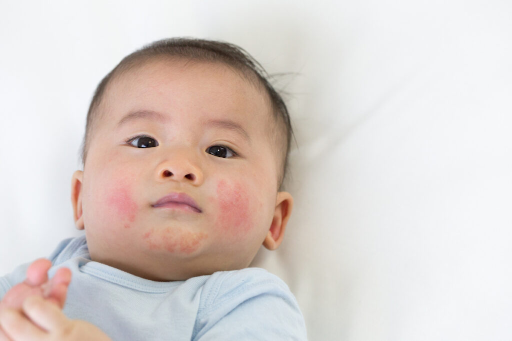 Baby with a skin rash that may have been prevented by early introduction of allergens